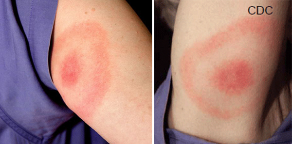 A picture of a circular rash caused by the bite of an infected blacklegged tick, called erythema migrans or commonly known as the “bull’s-eye” rash.