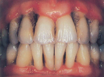 tobacco smoking and its effect on periodontal disease essay Gum (periodontal) disease is an infection of the gums and can affect the bone structure that supports your teeth in severe cases, it can make your teeth fall out smoking is an important cause of severe gum disease in the united states 1 gum disease starts with bacteria (germs) on your teeth that. tobacco smoking and its effect on periodontal disease essay Gum (periodontal) disease is an infection of the gums and can affect the bone structure that supports your teeth in severe cases, it can make your teeth fall out smoking is an important cause of severe gum disease in the united states 1 gum disease starts with bacteria (germs) on your teeth that.