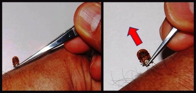 A picture of how to properly remove a tick, by pulling straight up from the skin using tweezers and steady pressure.