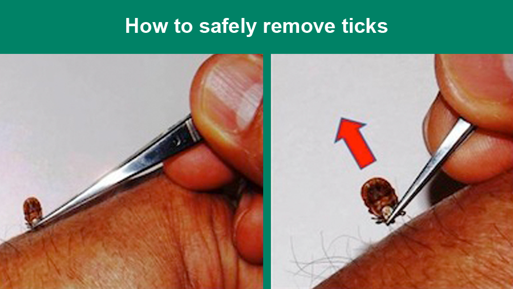 How to safely remove ticks