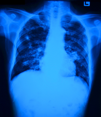 TB Chest X-ray