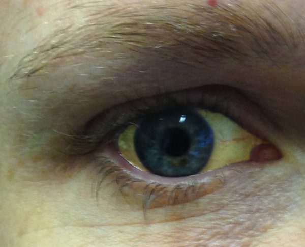 Image of an eye with jaundice